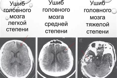 Предупреждение субатрофии головного мозга