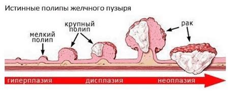 Признаки и обнаружение полипа