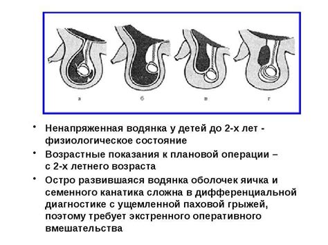 Признаки неопущенного яичка у ребенка