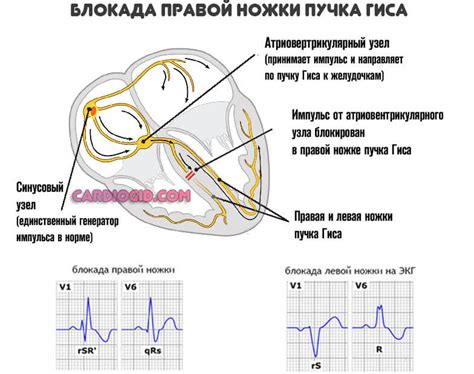 Причины блокады ножек и пучка гиса