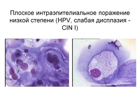 Причины возникновения атипичных клеток плоского эпителия