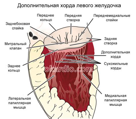 Причины возникновения ложной хорды левого желудочка