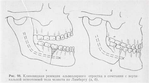 Причины возникновения отростка