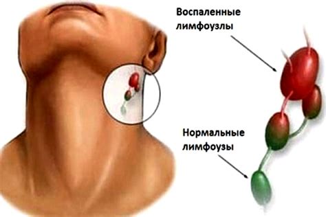 Причины воспаления лимфоузла