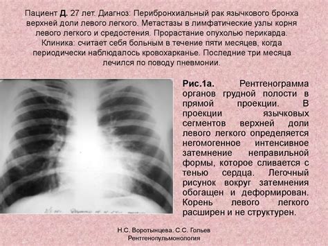 Причины деформации легочного рисунка на рентгене