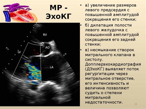 Причины дилатации левого предсердия