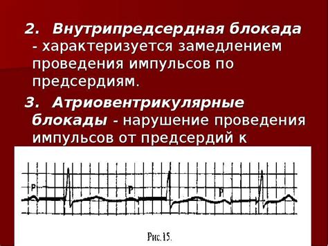 Причины замедления проводимости на ЭКГ