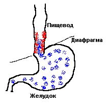 Причины и профилактика эзофагита