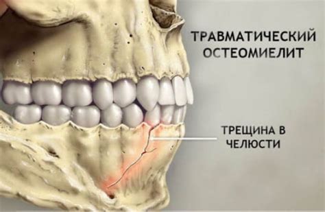 Причины и симптомы защемления челюсти