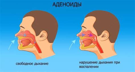 Причины и способы облегчить дыхание