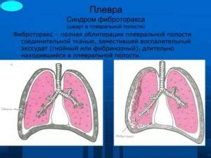 Причины плевральной шварта