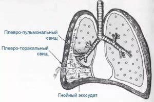 Причины плевропульмональных спаек в легких