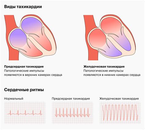 Причины повышенного пульса в состоянии покоя