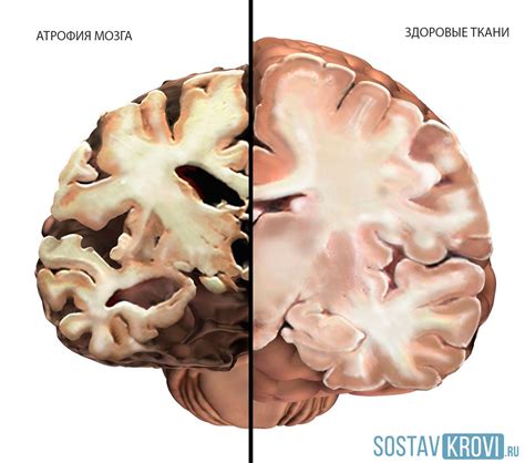 Причины развития атрофии головного мозга