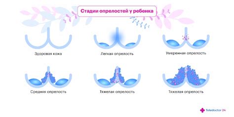 Причины развития опрелостей у детей в паховой области