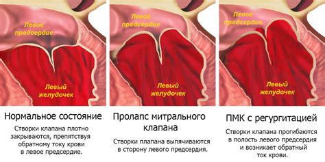 Причины развития пролапса митрального клапана