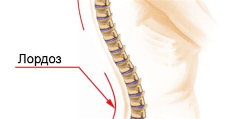 Причины сглаженного лордоза