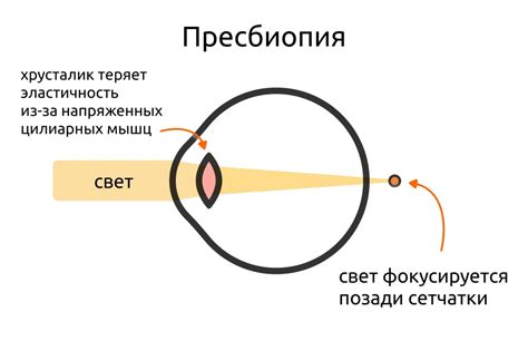 Причины смешанной рефракции