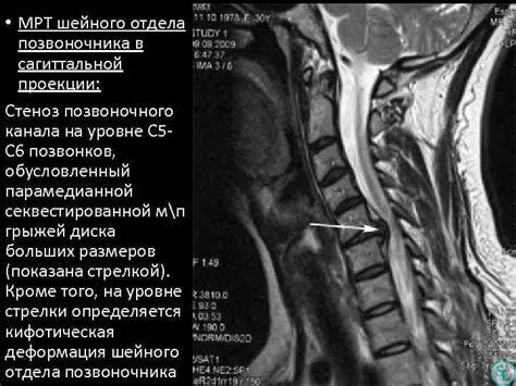 Причины стеноза шейного отдела позвоночника