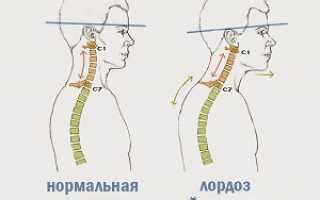 Проблемы с лордозом шейного отдела влияют на здоровье