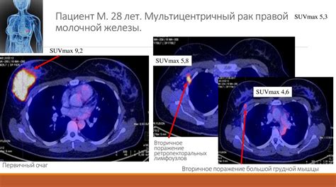 Прогноз и предупреждение реактивного генеза при ПЭТ-КТ