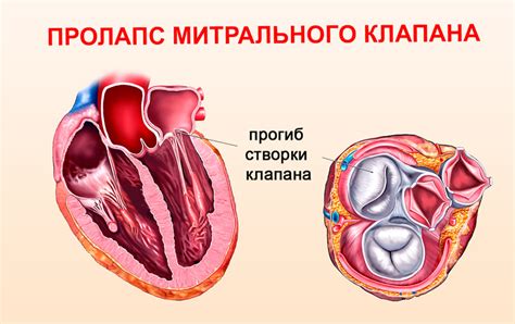 Пролапс митрального клапана без нарушения гемодинамики: особенности