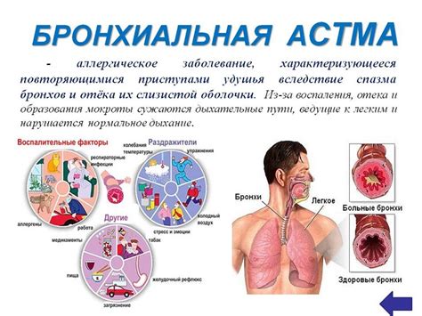 Профилактика бронхиальной астмы: