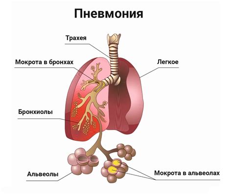 Профилактика и лечение пневмонии