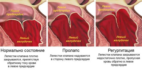 Профилактика и прогноз пролапса митрального клапана без нарушения гемодинамики