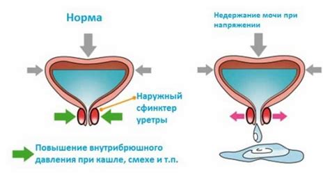 Профилактика красной мочи у женщин