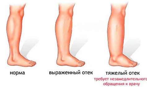 Профилактика отечности ноги: советы и рекомендации