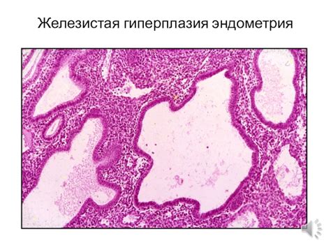 Профилактика простой железистой гиперплазии без атипии