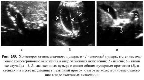 Профилактика утолщенных стенок желчного пузыря