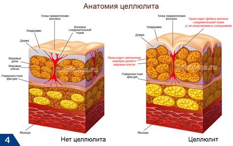 Пятая причина: отложение жировых клеток на месте укола