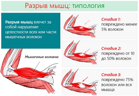 Разрыв мышц