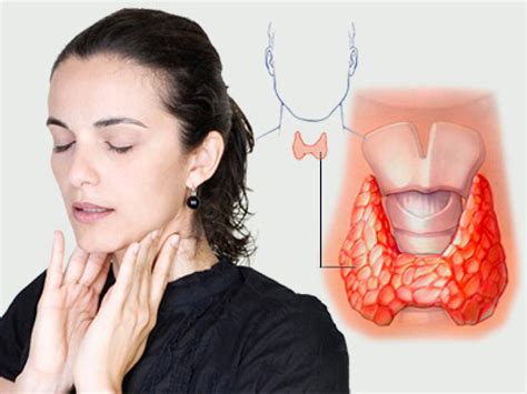 Расстройства щитовидной железы