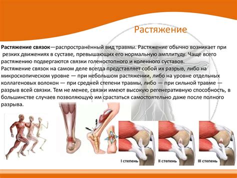 Растяжение связок и сухожилий