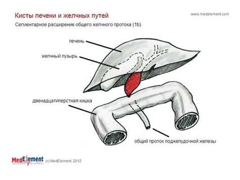 Расширение желчного протока: