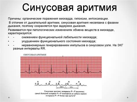 Регулярный синусовый ритм: определение и характеристики