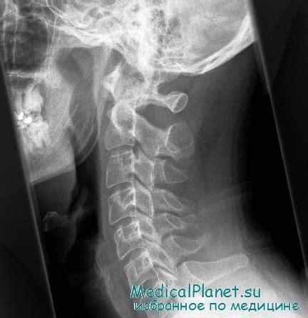 Результаты рентгенографии шейного отдела позвоночника