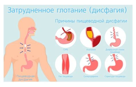 Решения проблемы затрудненного переваривания пищи в пищеводе