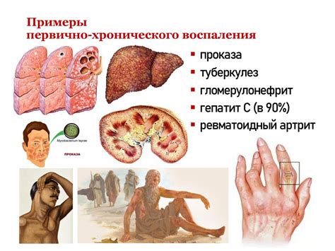 Роль воспаления в развитии вазогенного типа мелкоочаговых изменений