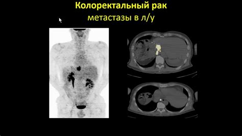 Роль реактивного генеза в диагностике ПЭТ-КТ