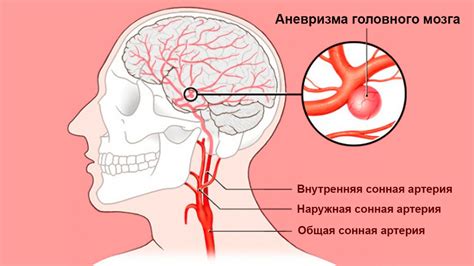 Роль стресса в расширении сосудов головного мозга