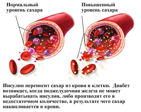 Сахар в крови: что происходит утром?