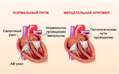 Сердечная аритмия