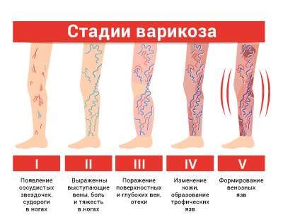 Сердечно-сосудистые заболевания и отеки ног