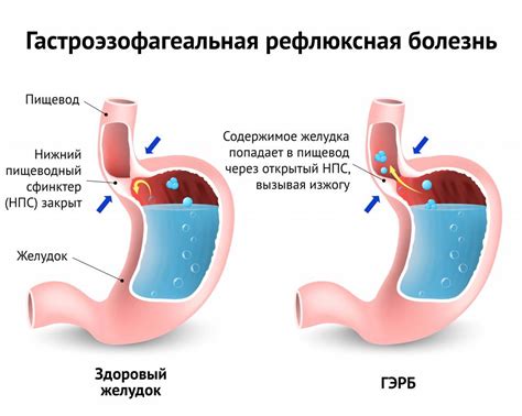 Сильные изжога и гариб (жжение может вызвать гариб)