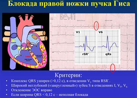 Симптомы блокады ножек и пучка гиса