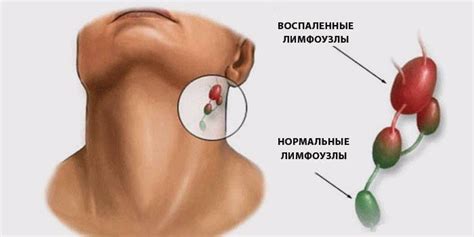 Симптомы воспаления лимфоузла и его последствия